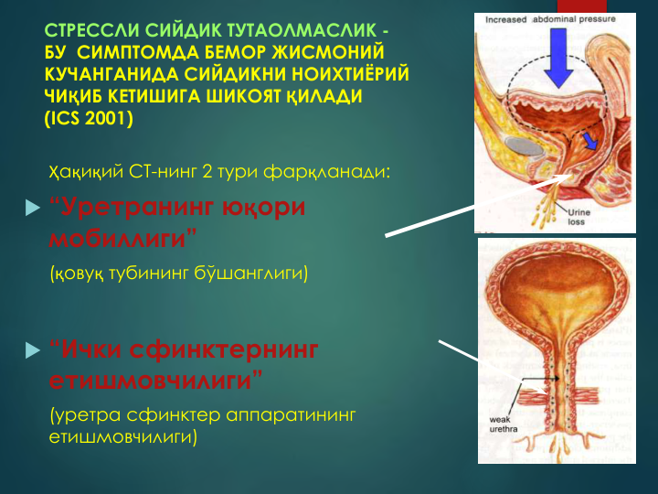 СТРЕССЛИ СИЙДИК ТУТАОЛМАСЛИК -
БУ  СИМПТОМДА БЕМОР ЖИСМОНИЙ 
КУЧАНГАНИДА СИЙДИКНИ НОИХТИЁРИЙ 
ЧИҚИБ КЕТИШИГА ШИКОЯТ ҚИЛАДИ
(ICS 2001)
Ҳақиқий СТ-нинг 2 тури фарқланади:
 “Уретранинг юқори 
мобиллиги”
(қовуқ тубининг бўшанглиги)
 “Ички сфинктернинг 
етишмовчилиги” 
(уретра сфинктер аппаратининг 
етишмовчилиги)
10
