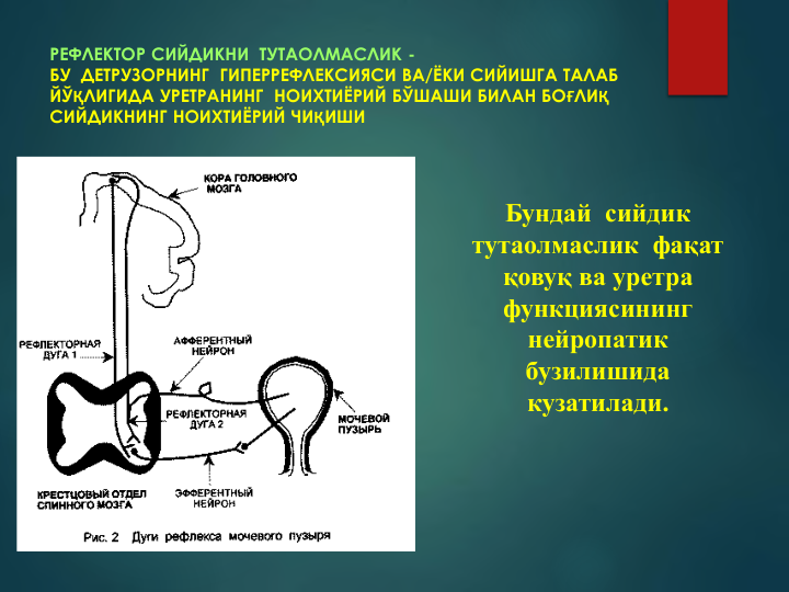 РЕФЛЕКТОР СИЙДИКНИ  ТУТАОЛМАСЛИК -
БУ  ДЕТРУЗОРНИНГ  ГИПЕРРЕФЛЕКСИЯСИ ВА/ЁКИ СИЙИШГА ТАЛАБ 
ЙЎҚЛИГИДА УРЕТРАНИНГ  НОИХТИЁРИЙ БЎШАШИ БИЛАН БОҒЛИҚ
СИЙДИКНИНГ НОИХТИЁРИЙ ЧИҚИШИ
Бундай  сийдик 
тутаолмаслик  фақат 
қовуқ ва уретра 
функциясининг 
нейропатик  
бузилишида 
кузатилади.
