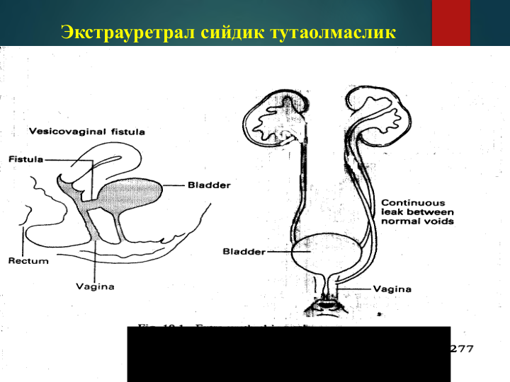 Экстрауретрал сийдик тутаолмаслик
