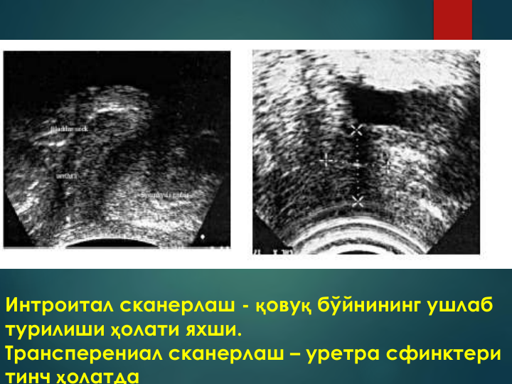 Интроитал сканерлаш - қовуқ бўйнининг ушлаб 
турилиши ҳолати яхши.  
Трансперениал сканерлаш – уретра сфинктери 
тинч ҳолатда
