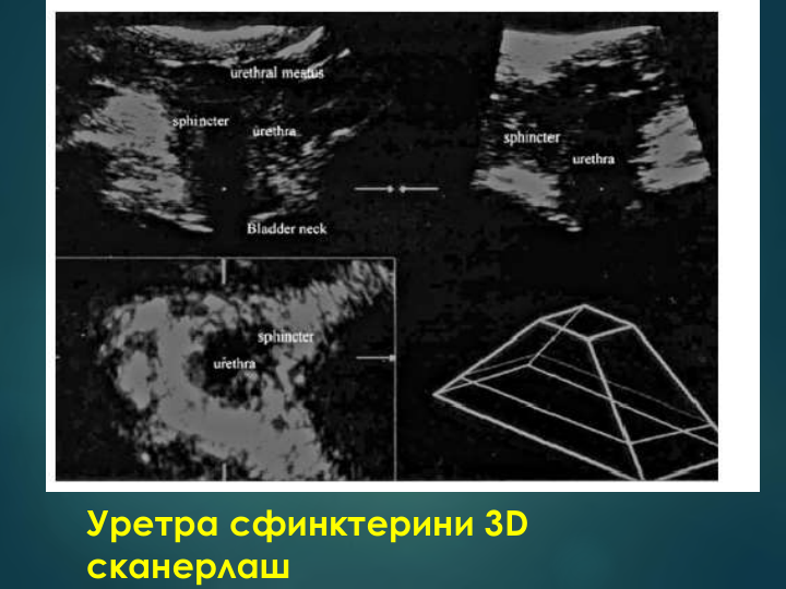 Уретра сфинктерини 3D 
cканерлаш 
