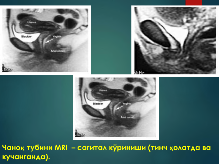 Чаноқ тубини MRI – сагитал кўриниши (тинч ҳолатда ва 
кучанганда).
