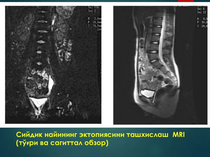 Сийдик найининг эктопиясини ташхислаш MRI
(тўғри ва сагиттал обзор)
