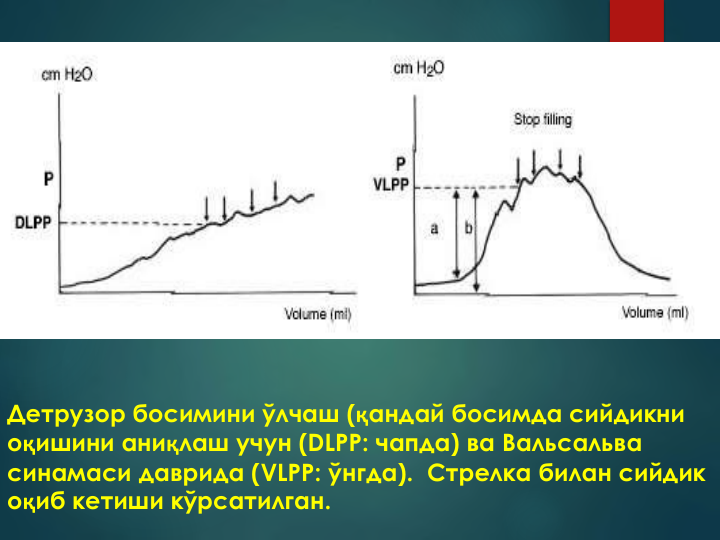 Детрузор босимини ўлчаш (қандай босимда сийдикни 
оқишини аниқлаш учун (DLPP: чапда) ва Вальсальва 
синамаси даврида (VLPP: ўнгда). Стрелка билан сийдик 
оқиб кетиши кўрсатилган. 

