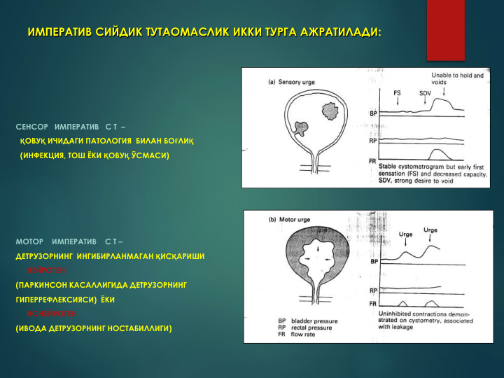 ИМПЕРАТИВ СИЙДИК ТУТАОМАСЛИК ИККИ ТУРГА АЖРАТИЛАДИ:
СЕНСОР   ИМПЕРАТИВ   С Т  –
ҚОВУҚ ИЧИДАГИ ПАТОЛОГИЯ  БИЛАН БОҒЛИҚ
(ИНФЕКЦИЯ, ТОШ ЁКИ ҚОВУҚ ЎСМАСИ)
МОТОР    ИМПЕРАТИВ    С Т –
ДЕТРУЗОРНИНГ  ИНГИБИРЛАНМАГАН ҚИСҚАРИШИ 
НЕЙРОГЕН
(ПАРКИНСОН КАСАЛЛИГИДА ДЕТРУЗОРНИНГ
ГИПЕРРЕФЛЕКСИЯСИ)  ЁКИ
НОНЕЙРОГЕН
(ИВОДА ДЕТРУЗОРНИНГ НОСТАБИЛЛИГИ)
