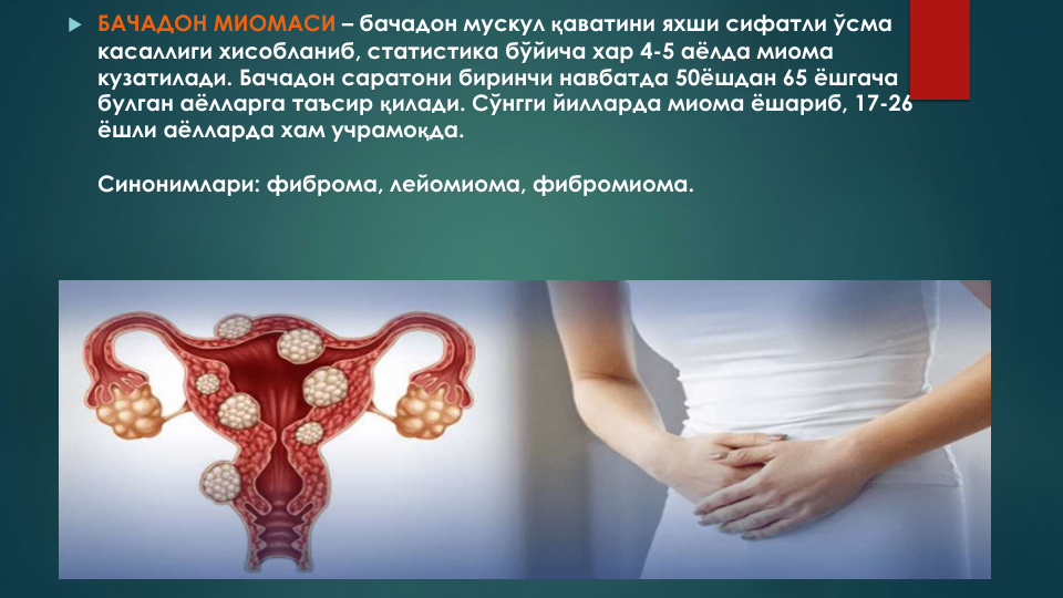  БАЧАДОН МИОМАСИ – бачадон мускул қаватини яхши сифатли ўсма
касаллиги хисобланиб, статистика бўйича хар 4-5 аёлда миома 
кузатилади. Бачадон саратони биринчи навбатда 50ёшдан 65 ёшгача
булган аёлларга таъсир қилади. Сўнгги йилларда миома ёшариб, 17-26 
ёшли аёлларда хам учрамоқда.
Синонимлари: фиброма, лейомиома, фибромиома.
