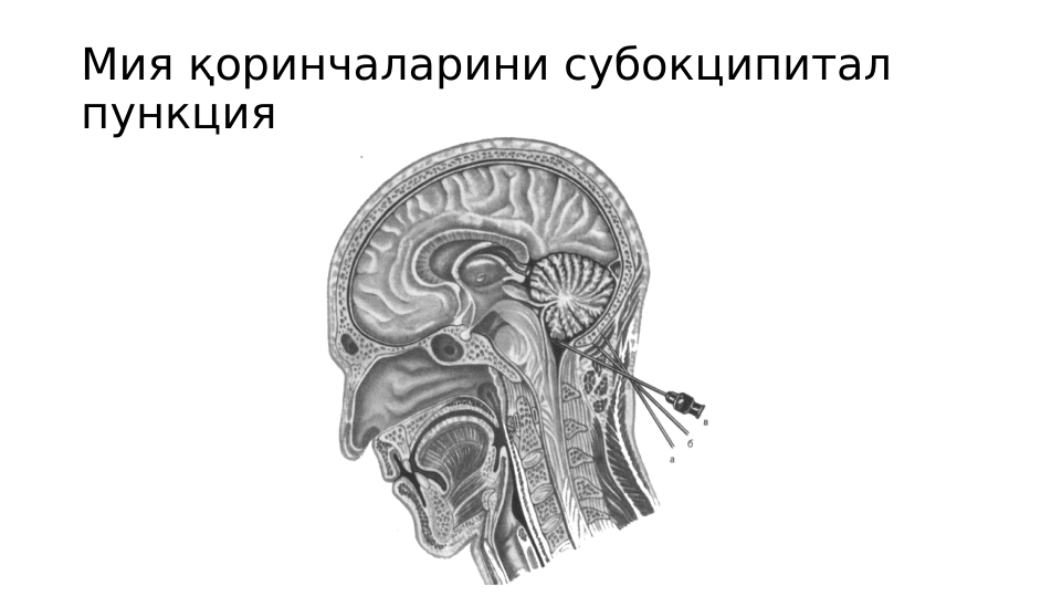 Мия қоринчаларини субокципитал 
пункция

