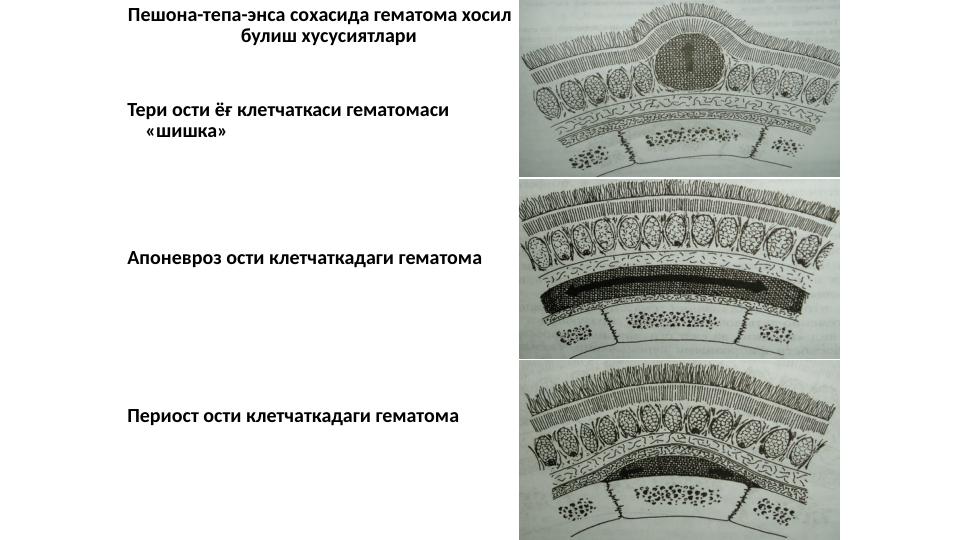 Пешона-тепа-энса сохасида гематома хосил 
булиш хусусиятлари
Тери ости ёғ клетчаткаси гематомаси 
«шишка»
Апоневроз ости клетчаткадаги гематома
Периост ости клетчаткадаги гематома
