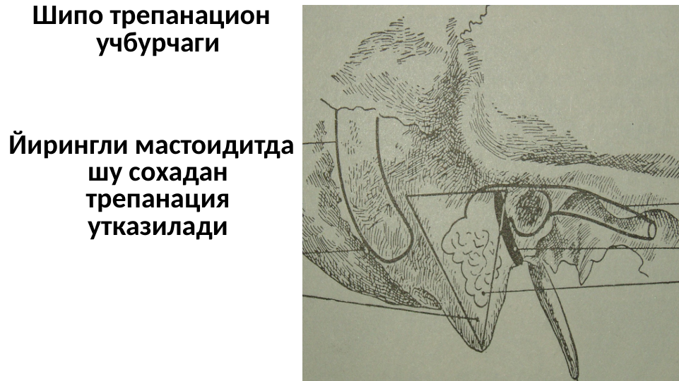 Шипо трепанацион 
учбурчаги
Йирингли мастоидитда 
шу сохадан 
трепанация 
утказилади
  
