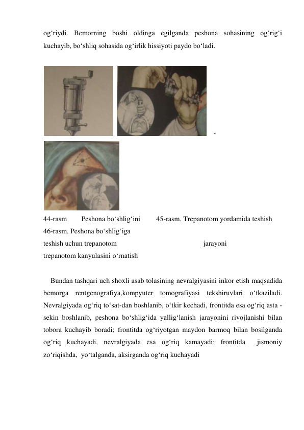 og‘riydi. Bemorning boshi oldinga egilganda peshona sohasining og‘rig‘i 
kuchayib, bo‘shliq sohasida og‘irlik hissiyoti paydo bo‘ladi. 
 
  
    -
 
44-rasm 
 Peshona bo‘shlig‘ini         45-rasm. Trepanotom yordamida teshish           
46-rasm. Peshona bo‘shlig‘iga   
teshish uchun trepanotom 
                                       jarayoni 
 
 
        
trepanotom kanyulasini o‘rnatish 
 
 
 
    Bundan tashqari uch shoxli asab tolasining nevralgiyasini inkor etish maqsadida 
bemorga rentgenografiya,kompyuter tomografiyasi tekshiruvlari o‘tkaziladi. 
Nevralgiyada og‘riq to‘sat-dan boshlanib, o‘tkir kechadi, frontitda esa og‘riq asta - 
sekin boshlanib, peshona bo‘shlig‘ida yallig‘lanish jarayonini rivojlanishi bilan 
tobora kuchayib boradi; frontitda og‘riyotgan maydon barmoq bilan bosilganda 
og‘riq kuchayadi, nevralgiyada esa og‘riq kamayadi; frontitda  jismoniy 
zo‘riqishda,  yo‘talganda, aksirganda og‘riq kuchayadi  
 
 
 
 
 
 
