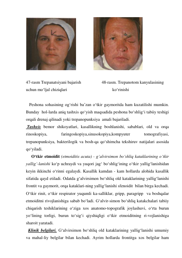                 
 
 
47-rasm Trepanatsiyani bajarish  
 
48-rasm. Trepanotom kanyulasining  
uchun mo‘ljal chiziqlari   
 
 
          ko‘rinishi 
 
   Peshona sohasining og‘rishi ba’zan o‘tkir gaymoritda ham kuzatilishi mumkin. 
Bunday  hol-larda aniq tashxis qo‘yish maqsadida peshona bo‘shlig‘i tabiiy teshigi 
orqali drenaj qilinadi yoki trepanopunksiya  amali bajariladi. 
 Tashxis bemor shikoyatlari, kasallikning boshlanishi, sabablari, old va orqa 
rinoskopiya, 
faringoskopiya,sinusokopiya,kompyuter 
tomografiyasi, 
trepanopunksiya, bakterilogik va bosh-qa qo‘shimcha tekshiruv natijalari asosida 
qo‘yiladi. 
     O‘tkir etmoidit (etmoiditis acuta) - g‘alvirsimon bo‘shliq kataklarining o‘tkir 
yallig‘-lanishi ko‘p uchraydi va yuqori jag‘ bo‘shlig‘ining o‘tkir yallig‘lanishidan 
keyin ikkinchi o‘rinni egalaydi. Kasallik kamdan - kam hollarda alohida kasallik 
sifatida qayd etiladi. Odatda g‘alvirsimon bo‘shliq old kataklarining yallig‘lanishi 
frontit va gaymorit, orqa kataklari-ning yallig‘lanishi sfenoidit  bilan birga kechadi. 
O‘tkir rinit, o‘tkir respirator yuqumli ka-salliklar, gripp, paragripp  va boshqalar 
etmoiditni rivojlanishiga sabab bo‘ladi. G‘alvir-simon bo‘shliq katakchalari tabiiy 
chiqarish teshiklarining o‘ziga xos anatomo-topografik joylashuvi, o‘rta burun 
yo‘lining torligi, burun to‘sig‘i qiyshiqligi o‘tkir etmoiditning ri-vojlanishiga 
sharoit yaratadi.  
  Klinik belgilari. G‘alvirsimon bo‘shliq old kataklarining yallig‘lanishi umumiy 
va mahal-liy belgilar bilan kechadi. Ayrim hollarda frontitga xos belgilar ham 
