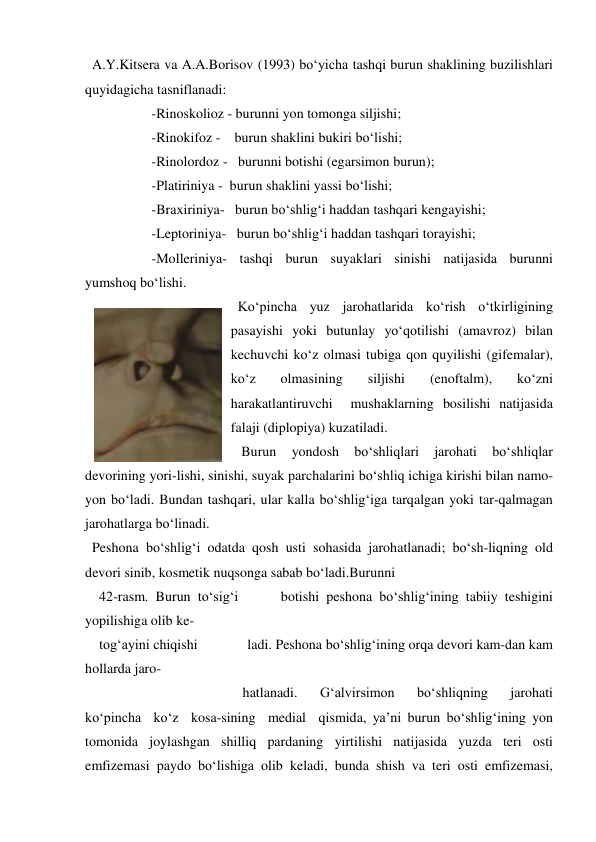   A.Y.Kitsera va A.A.Borisov (1993) bo‘yicha tashqi burun shaklining buzilishlari 
quyidagicha tasniflanadi: 
                   -Rinoskolioz - burunni yon tomonga siljishi; 
                   -Rinokifoz -    burun shaklini bukiri bo‘lishi; 
                   -Rinolordoz -   burunni botishi (egarsimon burun); 
                   -Platiriniya -  burun shaklini yassi bo‘lishi; 
                   -Braxiriniya-   burun bo‘shlig‘i haddan tashqari kengayishi;  
                   -Leptoriniya-   burun bo‘shlig‘i haddan tashqari torayishi; 
                   -Molleriniya- tashqi burun suyaklari sinishi natijasida burunni 
yumshoq bo‘lishi. 
  Ko‘pincha yuz jarohatlarida ko‘rish o‘tkirligining 
pasayishi yoki butunlay yo‘qotilishi (amavroz) bilan 
kechuvchi ko‘z olmasi tubiga qon quyilishi (gifemalar), 
ko‘z 
olmasining 
siljishi 
(enoftalm), 
ko‘zni 
harakatlantiruvchi  mushaklarning bosilishi natijasida 
falaji (diplopiya) kuzatiladi.   
   Burun 
yondosh 
bo‘shliqlari 
jarohati 
bo‘shliqlar 
devorining yori-lishi, sinishi, suyak parchalarini bo‘shliq ichiga kirishi bilan namo-
yon bo‘ladi. Bundan tashqari, ular kalla bo‘shlig‘iga tarqalgan yoki tar-qalmagan 
jarohatlarga bo‘linadi.  
  Peshona bo‘shlig‘i odatda qosh usti sohasida jarohatlanadi; bo‘sh-liqning old 
devori sinib, kosmetik nuqsonga sabab bo‘ladi.Burunni  
    42-rasm. Burun to‘sig‘i      botishi peshona bo‘shlig‘ining tabiiy teshigini 
yopilishiga olib ke- 
    tog‘ayini chiqishi              ladi. Peshona bo‘shlig‘ining orqa devori kam-dan kam 
hollarda jaro-                
                                             hatlanadi. 
G‘alvirsimon 
bo‘shliqning 
jarohati 
ko‘pincha  ko‘z  kosa-sining  medial  qismida, ya’ni burun bo‘shlig‘ining yon 
tomonida joylashgan shilliq pardaning yirtilishi natijasida yuzda teri osti 
emfizemasi paydo bo‘lishiga olib keladi, bunda shish va teri osti emfizemasi, 
