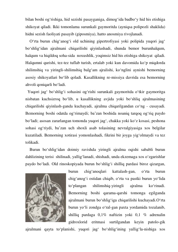 bilan boshi og‘rishiga, hid sezishi pasayganiga, dimog‘ida badbo‘y hid his etishiga 
shikoyat qiladi. Ikki tomonlama surunkali gaymoritda (ayniqsa polipozli shaklida) 
hidni sezish faoliyati pasayib (giposmiya), hatto anosmiya rivojlanadi. 
    O‘rta burun chig‘anog‘i old uchining gipertrofiyasi yoki polipida yuqori jag‘ 
bo‘shlig‘idan ajralmani chiqarilishi qiyinlashadi, shunda bemor burunhalqum, 
halqum va hiqildoq soha-sida  noxushlik, yoqimsiz hid his etishiga shikoyat  qiladi. 
Halqumni qurishi, tez-tez tuflab turish, ertalab yoki kun davomida ko‘p miqdorda 
shilimshiq va yiringli-shilimshiq balg‘am ajralishi, ko‘nglini aynishi bemorning 
asosiy shikoyatlari bo‘lib qoladi. Kasallikning re-missiya davrida esa bemorning 
ahvoli qoniqarli bo‘ladi.  
  Yuqori jag‘ bo‘shlig‘i sohasini og‘rishi surunkali gaymoritda o‘tkir gaymoritga 
nisbatan kuchsizroq bo‘lib, u kasallikning avjida yoki bo‘shliq ajralmasining 
chiqarilishi qiyinlash-ganda kuchayadi, ajralma chiqarilgandan co‘ng - cusayadi. 
Bemorning boshi odatda og‘rimaydi; ba’zan boshida noaniq tarqoq og‘riq paydo 
bo‘ladi; asosan zararlangan tomonda yuqori jag‘, chakka yoki ko‘z kosasi, peshona 
sohasi og‘riydi, ba’zan uch shoxli asab tolasining nevralgiyasiga xos belgilar 
kuzatiladi. Bemorning xotirasi yomonlashadi, fikrini bir joyga yig‘olmaydi va tez 
tolikadi.   
    Burun bo‘shlig‘idan doimiy ravishda yiringli ajralma oqishi sababli burun 
dahlizining terisi  shilinadi, yallig‘lanadi, shishadi, unda ekzemaga xos o‘zgarishlar 
paydo bo‘ladi. Old rinoskopiyada burun bo‘shlig‘i shilliq pardasi biroz qizargan, 
burun 
chig‘anoqlari 
kattalash-gan, 
o‘rta 
burun 
chig‘anog‘i ostidan chiqib, o‘rta va pastki burun yo‘lida 
to‘plangan 
shilimshiq-yiringli 
ajralma 
ko‘rinadi. 
Bemorning boshi qarama-qarshi tomonga egilganda 
ajralmani burun bo‘shlig‘iga chiqarilishi kuchayadi.O‘rta 
burun yo‘li zondga o‘ral-gan paxta yordamida tozalanib, 
shilliq pardaga 0,1% naftizin yoki 0,1 % adrenalin 
gidroxlorid eritmasi surtilgandan keyin patolo-gik 
ajralmani qayta to‘planishi, yuqori jag‘ bo‘shlig‘ining yallig‘la-nishiga xos 
