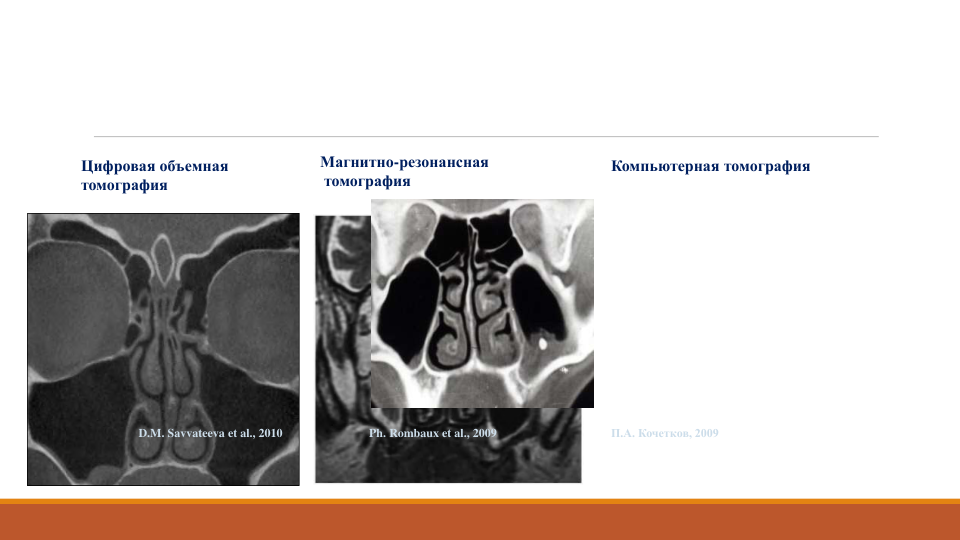 D.M. Savvateeva et al., 2010
Цифровая объемная 
томография 
Ph. Rombaux et al., 2009
Магнитно-резонансная
томография
Компьютерная томография
П.А. Кочетков, 2009
