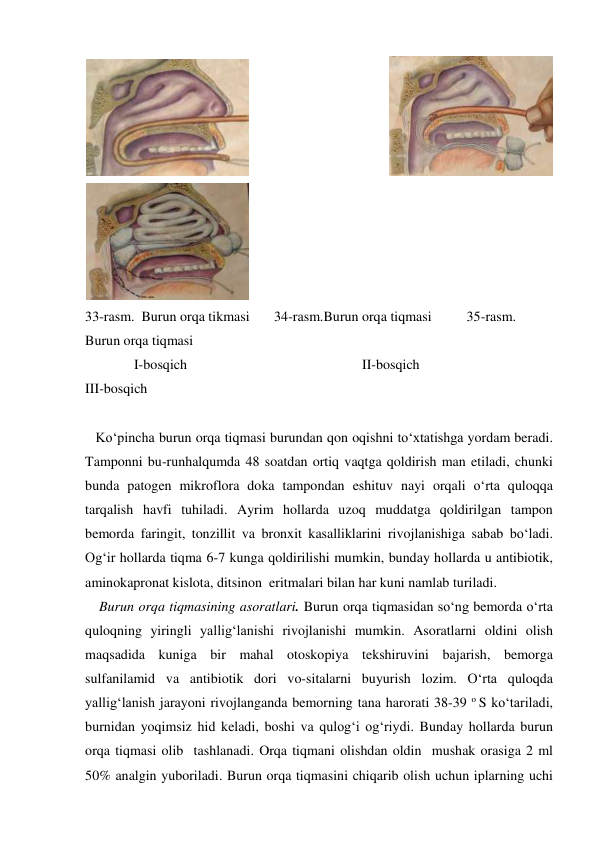   
 
   
 
33-rasm.  Burun orqa tikmasi       34-rasm.Burun orqa tiqmasi          35-rasm. 
Burun orqa tiqmasi                          
              I-bosqich                                                  II-bosqich                                           
III-bosqich 
 
   Ko‘pincha burun orqa tiqmasi burundan qon oqishni to‘xtatishga yordam beradi. 
Tamponni bu-runhalqumda 48 soatdan ortiq vaqtga qoldirish man etiladi, chunki 
bunda patogen mikroflora doka tampondan eshituv nayi orqali o‘rta quloqqa 
tarqalish havfi tuhiladi. Ayrim hollarda uzoq muddatga qoldirilgan tampon 
bemorda faringit, tonzillit va bronxit kasalliklarini rivojlanishiga sabab bo‘ladi. 
Og‘ir hollarda tiqma 6-7 kunga qoldirilishi mumkin, bunday hollarda u antibiotik, 
aminokapronat kislota, ditsinon  eritmalari bilan har kuni namlab turiladi.    
    Burun orqa tiqmasining asoratlari. Burun orqa tiqmasidan so‘ng bemorda o‘rta 
quloqning yiringli yallig‘lanishi rivojlanishi mumkin. Asoratlarni oldini olish 
maqsadida kuniga bir mahal otoskopiya tekshiruvini bajarish, bemorga 
sulfanilamid va antibiotik dori vo-sitalarni buyurish lozim. O‘rta quloqda 
yallig‘lanish jarayoni rivojlanganda bemorning tana harorati 38-39 o S ko‘tariladi, 
burnidan yoqimsiz hid keladi, boshi va qulog‘i og‘riydi. Bunday hollarda burun 
orqa tiqmasi olib  tashlanadi. Orqa tiqmani olishdan oldin  mushak orasiga 2 ml 
50% analgin yuboriladi. Burun orqa tiqmasini chiqarib olish uchun iplarning uchi  
