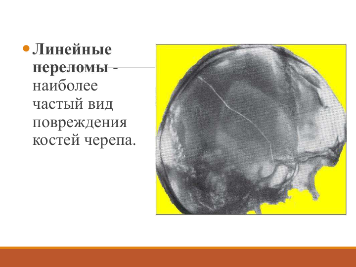 Линейные 
переломы -
наиболее 
частый вид 
повреждения 
костей черепа. 
