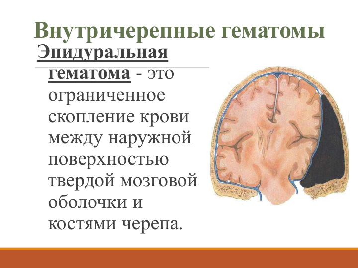 Внутричерепные гематомы
Эпидуральная
гематома - это 
ограниченное 
скопление крови 
между наружной 
поверхностью 
твердой мозговой 
оболочки и 
костями черепа. 
