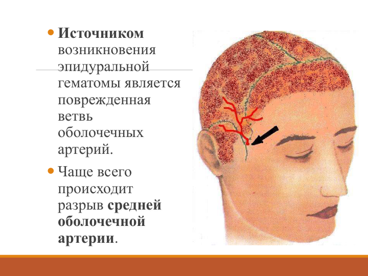  Источником 
возникновения 
эпидуральной
гематомы является 
поврежденная
ветвь 
оболочечных 
артерий.
 Чаще всего 
происходит 
разрыв средней 
оболочечной 
артерии. 
