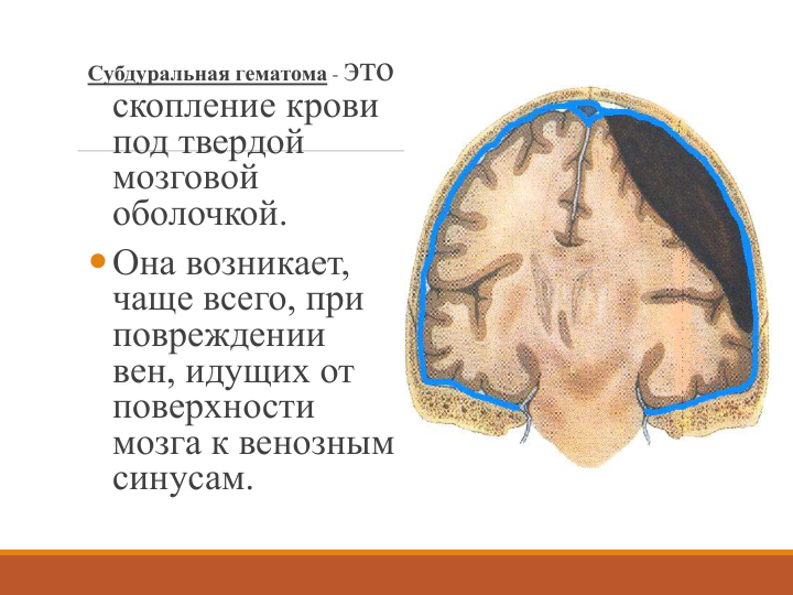 Субдуральная гематома -это 
скопление крови 
под твердой 
мозговой 
оболочкой. 
Она возникает, 
чаще всего, при 
повреждении 
вен, идущих от 
поверхности 
мозга к венозным 
синусам. 
