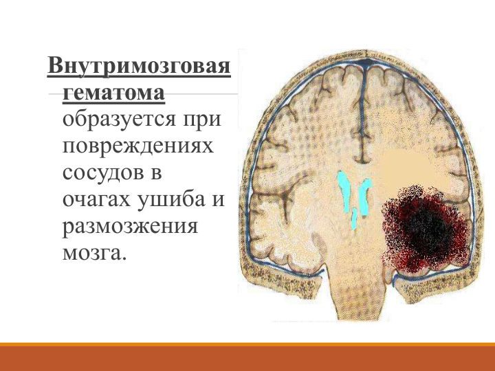 Внутримозговая 
гематома
образуется при 
повреждениях 
сосудов в 
очагах ушиба и 
размозжения 
мозга. 
