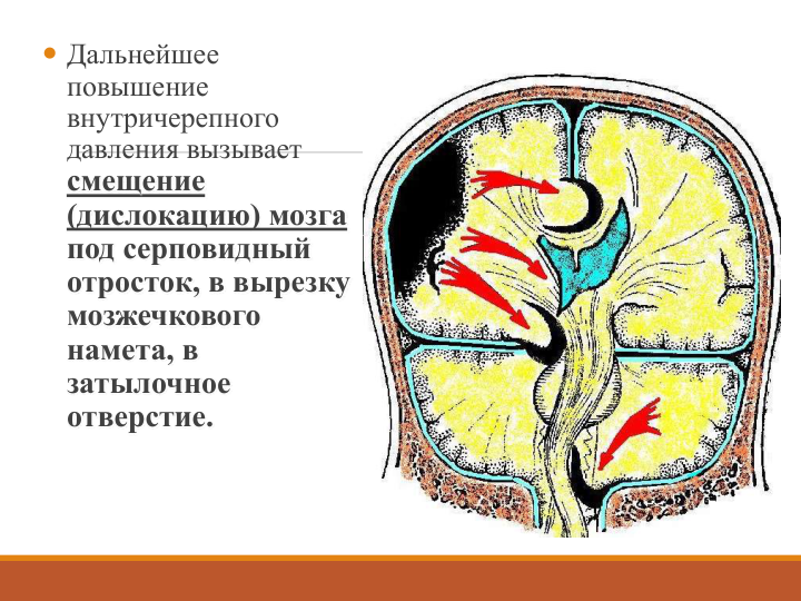  Дальнейшее 
повышение 
внутричерепного 
давления вызывает 
смещение 
(дислокацию) мозга
под серповидный 
отросток, в вырезку 
мозжечкового 
намета, в 
затылочное 
отверстие.
