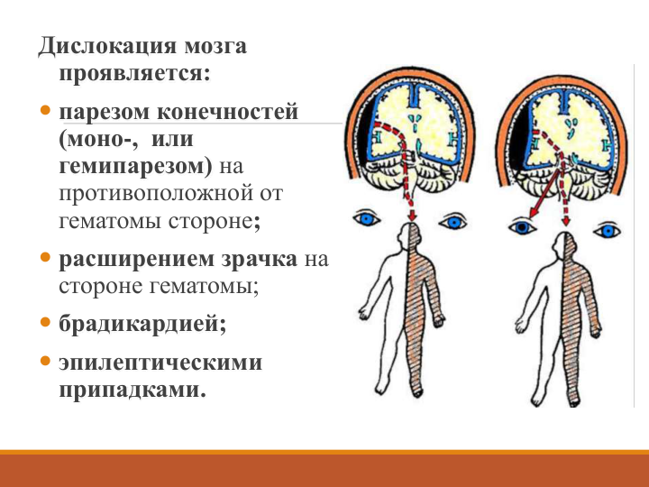 Дислокация мозга 
проявляется:
 парезом конечностей 
(моно-,  или 
гемипарезом) на 
противоположной от 
гематомы стороне; 
 расширением зрачка на 
стороне гематомы;
 брадикардией;
 эпилептическими 
припадками.
