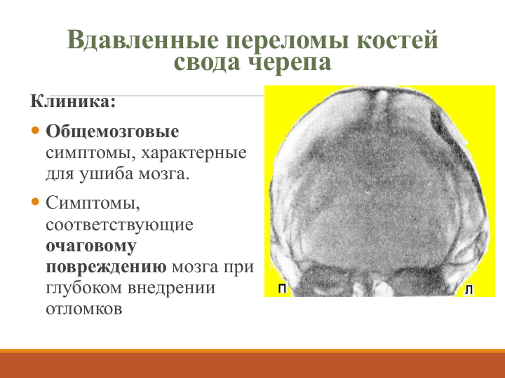 Вдавленные переломы костей 
свода черепа
Клиника:
 Общемозговые
симптомы, характерные 
для ушиба мозга.
 Симптомы, 
соответствующие
очаговому 
повреждению мозга при 
глубоком внедрении 
отломков 
