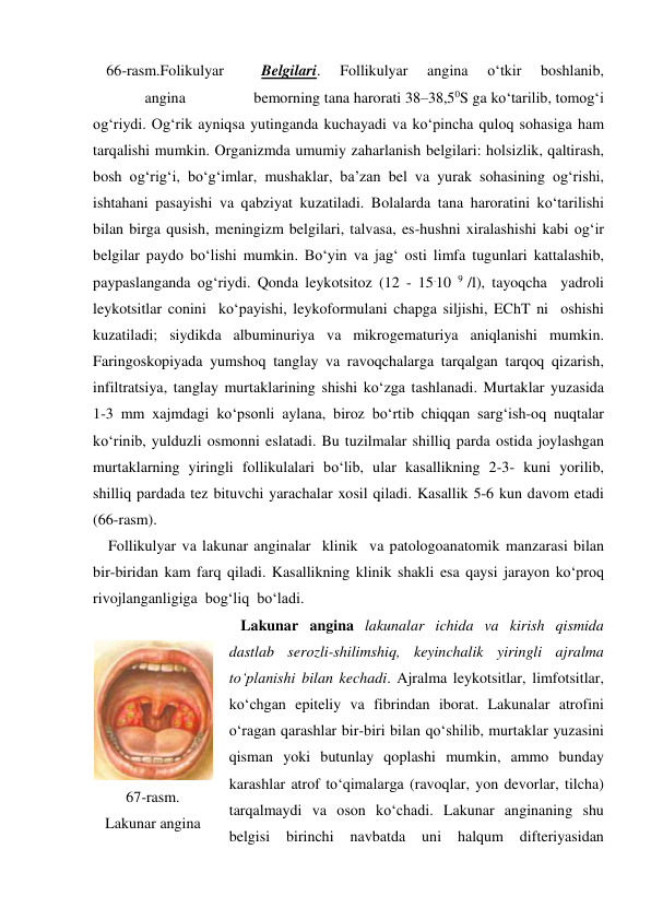   Belgilari. 
Follikulyar 
angina 
o‘tkir 
boshlanib, 
bemorning tana harorati 38–38,50S ga ko‘tarilib, tomog‘i 
og‘riydi. Og‘rik ayniqsa yutinganda kuchayadi va ko‘pincha quloq sohasiga ham 
tarqalishi mumkin. Organizmda umumiy zaharlanish belgilari: holsizlik, qaltirash, 
bosh og‘rig‘i, bo‘g‘imlar, mushaklar, ba’zan bel va yurak sohasining og‘rishi, 
ishtahani pasayishi va qabziyat kuzatiladi. Bolalarda tana haroratini ko‘tarilishi 
bilan birga qusish, meningizm belgilari, talvasa, es-hushni xiralashishi kabi og‘ir 
belgilar paydo bo‘lishi mumkin. Bo‘yin va jag‘ osti limfa tugunlari kattalashib, 
paypaslanganda og‘riydi. Qonda leykotsitoz (12 - 15.10 9 /l), tayoqcha  yadroli  
leykotsitlar conini  ko‘payishi, leykoformulani chapga siljishi, EChT ni  oshishi 
kuzatiladi; siydikda albuminuriya va mikrogematuriya aniqlanishi mumkin. 
Faringoskopiyada yumshoq tanglay va ravoqchalarga tarqalgan tarqoq qizarish, 
infiltratsiya, tanglay murtaklarining shishi ko‘zga tashlanadi. Murtaklar yuzasida 
1-3 mm xajmdagi ko‘psonli aylana, biroz bo‘rtib chiqqan sarg‘ish-oq nuqtalar 
ko‘rinib, yulduzli osmonni eslatadi. Bu tuzilmalar shilliq parda ostida joylashgan 
murtaklarning yiringli follikulalari bo‘lib, ular kasallikning 2-3- kuni yorilib, 
shilliq pardada tez bituvchi yarachalar xosil qiladi. Kasallik 5-6 kun davom etadi 
(66-rasm). 
    Follikulyar va lakunar anginalar  klinik  va patologoanatomik manzarasi bilan 
bir-biridan kam farq qiladi. Kasallikning klinik shakli esa qaysi jarayon ko‘proq 
rivojlanganligiga  bog‘liq  bo‘ladi.  
   Lakunar angina lakunalar ichida va kirish qismida 
dastlab serozli-shilimshiq, keyinchalik yiringli ajralma 
to‘planishi bilan kechadi. Ajralma leykotsitlar, limfotsitlar, 
ko‘chgan epiteliy va fibrindan iborat. Lakunalar atrofini 
o‘ragan qarashlar bir-biri bilan qo‘shilib, murtaklar yuzasini 
qisman yoki butunlay qoplashi mumkin, ammo bunday 
karashlar atrof to‘qimalarga (ravoqlar, yon devorlar, tilcha) 
tarqalmaydi va oson ko‘chadi. Lakunar anginaning shu 
belgisi 
birinchi 
navbatda 
uni 
halqum 
difteriyasidan 
66-rasm.Folikulyar 
angina 
 
67-rasm. 
Lakunar angina 
