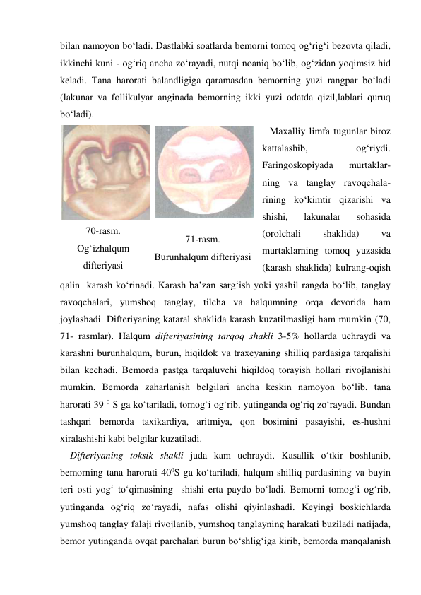 bilan namoyon bo‘ladi. Dastlabki soatlarda bemorni tomoq og‘rig‘i bezovta qiladi, 
ikkinchi kuni - og‘riq ancha zo‘rayadi, nutqi noaniq bo‘lib, og‘zidan yoqimsiz hid 
keladi. Tana harorati balandligiga qaramasdan bemorning yuzi rangpar bo‘ladi 
(lakunar va follikulyar anginada bemorning ikki yuzi odatda qizil,lablari quruq 
bo‘ladi).  
   Maxalliy limfa tugunlar biroz 
kattalashib, 
og‘riydi. 
Faringoskopiyada 
murtaklar-
ning va tanglay ravoqchala-
rining ko‘kimtir qizarishi va 
shishi, 
lakunalar 
sohasida 
(orolchali 
shaklida) 
va 
murtaklarning tomoq yuzasida 
(karash shaklida) kulrang-oqish 
qalin  karash ko‘rinadi. Karash ba’zan sarg‘ish yoki yashil rangda bo‘lib, tanglay 
ravoqchalari, yumshoq tanglay, tilcha va halqumning orqa devorida ham 
joylashadi. Difteriyaning kataral shaklida karash kuzatilmasligi ham mumkin (70, 
71- rasmlar). Halqum difteriyasining tarqoq shakli 3-5% hollarda uchraydi va 
karashni burunhalqum, burun, hiqildok va traxeyaning shilliq pardasiga tarqalishi 
bilan kechadi. Bemorda pastga tarqaluvchi hiqildoq torayish hollari rivojlanishi 
mumkin. Bemorda zaharlanish belgilari ancha keskin namoyon bo‘lib, tana 
harorati 39 0 S ga ko‘tariladi, tomog‘i og‘rib, yutinganda og‘riq zo‘rayadi. Bundan 
tashqari bemorda taxikardiya, aritmiya, qon bosimini pasayishi, es-hushni 
xiralashishi kabi belgilar kuzatiladi. 
    Difteriyaning toksik shakli juda kam uchraydi. Kasallik o‘tkir boshlanib, 
bemorning tana harorati 400S ga ko‘tariladi, halqum shilliq pardasining va buyin 
teri osti yog‘ to‘qimasining  shishi erta paydo bo‘ladi. Bemorni tomog‘i og‘rib, 
yutinganda og‘riq zo‘rayadi, nafas olishi qiyinlashadi. Keyingi boskichlarda 
yumshoq tanglay falaji rivojlanib, yumshoq tanglayning harakati buziladi natijada, 
bemor yutinganda ovqat parchalari burun bo‘shlig‘iga kirib, bemorda manqalanish 
 
 
70-rasm. 
Og‘izhalqum 
difteriyasi 
71-rasm. 
Burunhalqum difteriyasi 
