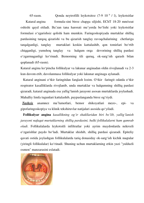  Qonda neytrofilli leykotsitoz (7-9 .10 9 / l), leykotsitlar 
formula-sini biroz chapga siljishi, EChT 18-20 mm/soat 
oshishi qayd etiladi. Ba’zan tana harorati me’yorda bo‘lishi yoki leykotsitlar 
formulasi o‘zgarishsiz qolishi ham mumkin. Faringoskopiyada murtaklar shilliq 
pardasining tarqoq qizarishi va bu qizarish tanglay ravoqchalarining  chetlariga  
tarqalganligi, tanglay  murtaklari keskin kattalashib, qon tomirlari bo‘rtib 
chiqqanligi, yumshoq tanglay  va  halqum orqa  devorining shilliq pardasi 
o‘zgarmaganligi ko‘rinadi. Bemorning tili quruq, ok-sarg‘ish qarash bilan 
qoplanadi (65-rasm). 
Kataral angina ko‘pincha follikulyar va lakunar anginadan oldin rivojlanadi va 2-3 
kun davom etib, davolanmasa follikulyar yoki lakunar anginaga aylanadi.  
   Kataral anginani o‘tkir faringitdan farqlash lozim. O‘tkir  faringit odatda o‘tkir 
respirator kasalliklarda rivojlanib, unda murtaklar va halqumning shilliq pardasi 
qizaradi, kataral anginada esa yallig‘lanish jarayoni asosan murtaklarda joylashadi. 
Mahalliy limfa tugunlari kattalashib, paypaslanganda biroz og‘riydi.  
  Tashxis 
anamnez 
ma’lumotlari, 
bemor 
shikoyatlari 
mezo-, 
epi- 
va 
gipofaringoskopiya va klinik tekshiruvlar natijalari asosida qo‘yiladi. 
   Follikulyar angina kasallikning og‘ir shakllaridan biri bo‘lib, yallig‘lanish 
jarayoni nafaqat murtaklarning shilliq pardasini, balki follikulalarni ham qamrab 
oladi. Follikulalarda leykotsitli infiltratlar yoki ayrim maydonlarda nekrozli 
o‘zgarishlar paydo bo‘ladi. Murtaklar shishib, shilliq pardasi qizaradi. Epiteliy 
qavati ostida joylashgan follikulalarda tariq donasiday ok-sarg‘ish kichik nuqtalar 
(yiringli follikulalar) ko‘rinadi. Shuning uchun murtaklarning erkin yuzi "yulduzli 
osmon" manzarasini eslatadi.  
65-rasm. 
Kataral angina 
 
