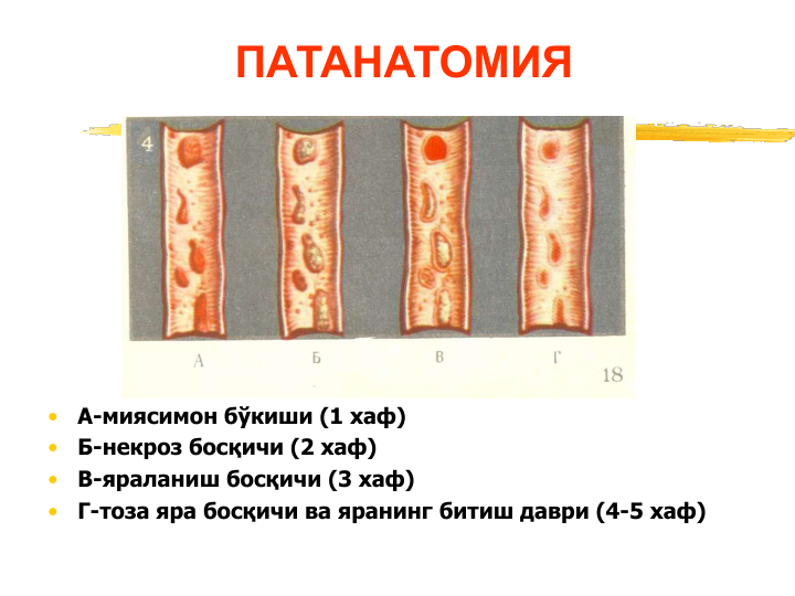 ПАТАНАТОМИЯ 
•
А-миясимон бўкиши (1 хаф)
•
Б-некроз босқичи (2 хаф)
•
В-яраланиш босқичи (3 хаф)
•
Г-тоза яра босқичи ва яранинг битиш даври (4-5 хаф) 
