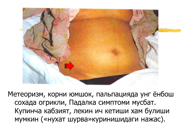 Метеоризм, корни юмшок, пальпацияда унг ёнбош 
сохада огрикли, Падалка симптоми мусбат. 
Купинча кабзият, лекин ич кетиши хам булиши 
мумкин («нухат шурва»куринишидаги нажас).

