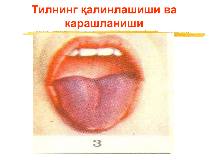 Тилнинг қалинлашиши ва 
карашланиши 
