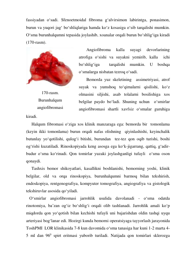 fassiyadan o‘sadi. Sfenoetmoidal fibroma g‘alvirsimon labirintga, ponasimon, 
burun va yuqori jag‘ bo‘shliqlariga hamda ko‘z kosasiga o‘sib tarqalishi mumkin. 
O‘sma burunhalqumni tepasida joylashib, xoanalar orqali burun bo‘shlig‘iga kiradi 
(170-rasm).     
       Angiofibroma 
kalla 
suyagi 
devorlarining 
atrofiga o‘sishi va suyakni yemirib, kalla  ichi 
bo‘shlig‘iga 
 
tarqalishi 
mumkin. 
U 
boshqa 
o‘smalarga nisbatan tezroq o‘sadi.  
       Bemorda yuz skeletining  assimetriyasi, atrof 
suyak va yumshoq to‘qimalarni qisilishi, ko‘z 
olmasini siljishi, asab tolalarni bosilishiga xos 
belgilar paydo bo‘ladi. Shuning uchun  o‘smirlar 
angiofibromasi shartli xavfsiz o‘smalar guruhiga 
kiradi. 
     Halqum fibromasi o‘ziga xos klinik manzaraga ega: bemorda bir  tomonlama 
(keyin ikki tomonlama) burun orqali nafas olishning  qiyinlashishi, keyinchalik 
butunlay yo‘qotilishi, qulog‘i bitishi, burundan  tez-tez qon oqib turishi, boshi 
og‘rishi kuzatiladi. Rinoskopiyada keng asosga ega ko‘k-jigarrang, qattiq, g‘adir-
budur o‘sma ko‘rinadi. Qon tomirlar yuzaki joylashganligi tufayli  o‘sma oson 
qonaydi. 
     Tashxis bemor shikoyatlari, kasallikni boshlanishi, bemorning yoshi, klinik 
belgilar, old va orqa rinoskopiya, burunhalqumni barmoq bilan tekshirish, 
endoskopiya, rentgenografiya, kompyuter tomografiya, angiografiya va gistologik 
tekshiruvlar asosida qo‘yiladi. 
   O‘smirlar angiofibromasi jarrohlik usulida davolanadi - o‘sma odatda 
rinotomiya, ba’zan og‘iz bo‘shlig‘i orqali olib tashlanadi. Jarrohlik amali ko‘p 
miqdorda qon yo‘qotish bilan kechishi tufayli uni bajarishdan oldin tashqi uyqu 
arteriyasi bog‘lanar edi. Hozirgi kunda bemorni operatsiyaga tayyorlash jarayonida 
ToshPMI  LOR klinikasida 7-8 kun davomida o‘sma tanasiga har kuni 1-2 marta 4-
5 ml dan 960 spirt eritmasi yuborib turiladi. Natijada qon tomirlari sklerozga 
 
170-rasm. 
Burunhalqum 
angiofibromasi 
