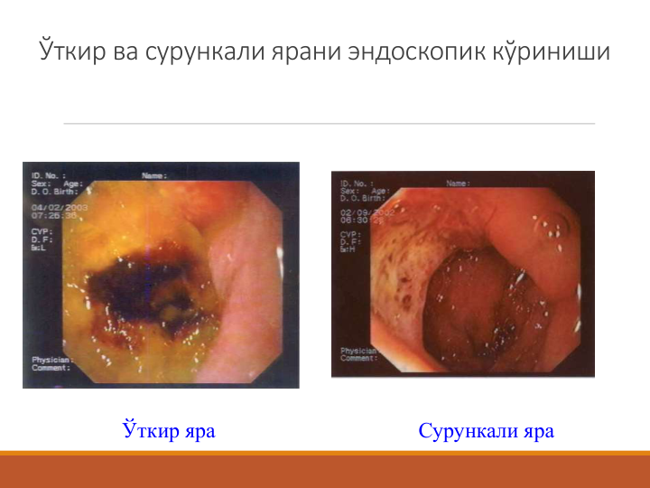 Ўткир ва сурункали ярани эндоскопик кўриниши
Ўткир яра
Сурункали яра
