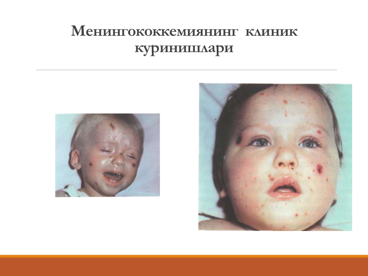 Менингококкемиянинг  клиник 
куринишлари

