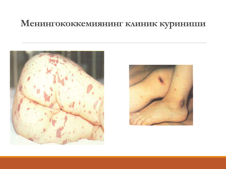 Менингококкемиянинг клиник куриниши
