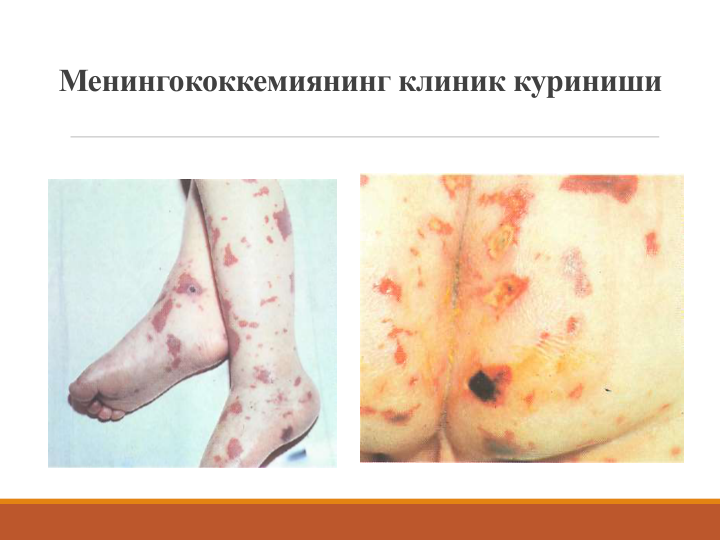 Менингококкемиянинг клиник куриниши
