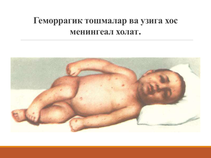 Геморрагик тошмалар ва узига хос 
менингеал холат.
