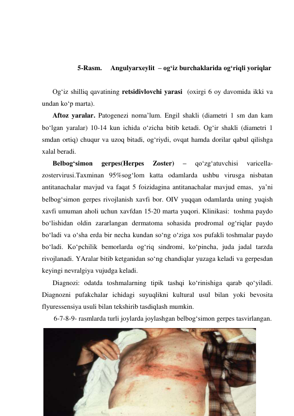  
 
 
 
 
 
5-Rasm.     Angulyarxeylit  – og‘iz burchaklarida og‘riqli yoriqlar 
 
Og‘iz shilliq qavatining retsidivlovchi yarasi  (oxirgi 6 oy davomida ikki va 
undan ko‘p marta). 
Aftoz yaralar. Patogenezi noma’lum. Engil shakli (diametri 1 sm dan kam 
bo‘lgan yaralar) 10-14 kun ichida o‘zicha bitib ketadi. Og‘ir shakli (diametri 1 
smdan ortiq) chuqur va uzoq bitadi, og‘riydi, ovqat hamda dorilar qabul qilishga 
xalal beradi. 
Belbog‘simon 
gerpes(Herpes 
Zoster) 
– 
qo‘zg‘atuvchisi 
varicella-
zostervirusi.Taxminan 95%sog‘lom katta odamlarda ushbu virusga nisbatan 
antitanachalar mavjud va faqat 5 foizidagina antitanachalar mavjud emas,  ya’ni 
belbog‘simon gerpes rivojlanish xavfi bor. OIV yuqqan odamlarda uning yuqish 
xavfi umuman aholi uchun xavfdan 15-20 marta yuqori. Klinikasi:  toshma paydo 
bo‘lishidan oldin zararlangan dermatoma sohasida prodromal og‘riqlar paydo 
bo‘ladi va o‘sha erda bir necha kundan so‘ng o‘ziga xos pufakli toshmalar paydo 
bo‘ladi. Ko‘pchilik bemorlarda og‘riq sindromi, ko‘pincha, juda jadal tarzda 
rivojlanadi. YAralar bitib ketganidan so‘ng chandiqlar yuzaga keladi va gerpesdan 
keyingi nevralgiya vujudga keladi. 
Diagnozi: odatda toshmalarning tipik tashqi ko‘rinishiga qarab qo‘yiladi. 
Diagnozni pufakchalar ichidagi suyuqlikni kultural usul bilan yoki bevosita 
flyuressensiya usuli bilan tekshirib tasdiqlash mumkin. 
 6-7-8-9- rasmlarda turli joylarda joylashgan belbog‘simon gerpes tasvirlangan.  
 
 
 
 
 
