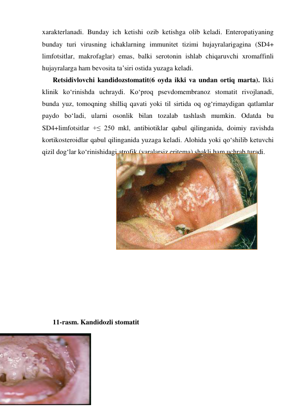 xarakterlanadi. Bunday ich ketishi ozib ketishga olib keladi. Enteropatiyaning 
bunday turi virusning ichaklarning immunitet tizimi hujayralarigagina (SD4+  
limfotsitlar, makrofaglar) emas, balki serotonin ishlab chiqaruvchi xromaffinli 
hujayralarga ham bevosita ta’siri ostida yuzaga keladi.  
Retsidivlovchi kandidozstomatit(6 oyda ikki va undan ortiq marta). Ikki 
klinik ko‘rinishda uchraydi. Ko‘proq psevdomembranoz stomatit rivojlanadi, 
bunda yuz, tomoqning shilliq qavati yoki til sirtida oq og‘rimaydigan qatlamlar 
paydo bo‘ladi, ularni osonlik bilan tozalab tashlash mumkin. Odatda bu 
SD4+limfotsitlar +≤ 250 mkl, antibiotiklar qabul qilinganida, doimiy ravishda 
kortikosteroidlar qabul qilinganida yuzaga keladi. Alohida yoki qo‘shilib ketuvchi 
qizil dog‘lar ko‘rinishidagi atrofik (yaralarsiz eritema) shakli ham uchrab turadi. 
 
 
 
 
 
 
 
 
 
 
 
 
 
11-rasm. Kandidozli stomatit 
 
 
 
 
