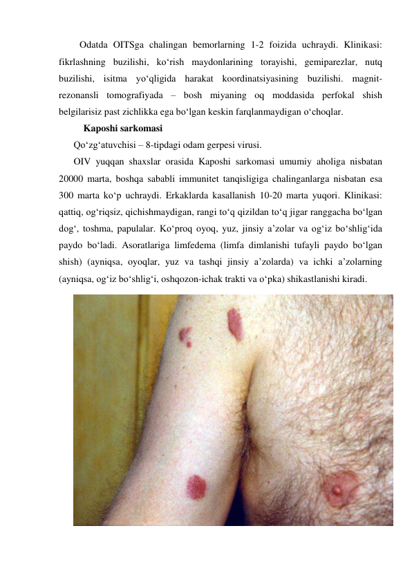  Odatda OITSga chalingan bemorlarning 1-2 foizida uchraydi. Klinikasi: 
fikrlashning buzilishi, ko‘rish maydonlarining torayishi, gemiparezlar, nutq 
buzilishi, isitma yo‘qligida harakat koordinatsiyasining buzilishi. magnit-
rezonansli tomografiyada – bosh miyaning oq moddasida perfokal shish 
belgilarisiz past zichlikka ega bo‘lgan keskin farqlanmaydigan o‘choqlar.     
 
  Kaposhi sarkomasi 
Qo‘zg‘atuvchisi – 8-tipdagi odam gerpesi virusi. 
OIV yuqqan shaxslar orasida Kaposhi sarkomasi umumiy aholiga nisbatan 
20000 marta, boshqa sababli immunitet tanqisligiga chalinganlarga nisbatan esa 
300 marta ko‘p uchraydi. Erkaklarda kasallanish 10-20 marta yuqori. Klinikasi: 
qattiq, og‘riqsiz, qichishmaydigan, rangi to‘q qizildan to‘q jigar ranggacha bo‘lgan 
dog‘, toshma, papulalar. Ko‘proq oyoq, yuz, jinsiy a’zolar va og‘iz bo‘shlig‘ida 
paydo bo‘ladi. Asoratlariga limfedema (limfa dimlanishi tufayli paydo bo‘lgan 
shish) (ayniqsa, oyoqlar, yuz va tashqi jinsiy a’zolarda) va ichki a’zolarning 
(ayniqsa, og‘iz bo‘shlig‘i, oshqozon-ichak trakti va o‘pka) shikastlanishi kiradi. 
 
 
 
 
 
 
 
 
 
 
 
 
 
 
 
