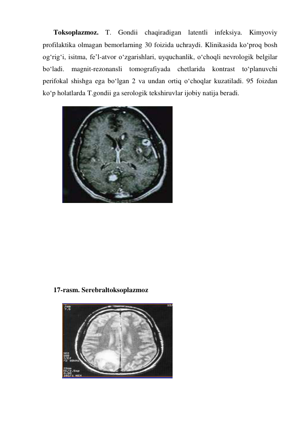 Toksoplazmoz. T. Gondii chaqiradigan latentli infeksiya. Kimyoviy 
profilaktika olmagan bemorlarning 30 foizida uchraydi. Klinikasida ko‘proq bosh 
og‘rig‘i, isitma, fe’l-atvor o‘zgarishlari, uyquchanlik, o‘choqli nevrologik belgilar 
bo‘ladi. magnit-rezonansli tomografiyada chetlarida kontrast to‘planuvchi 
perifokal shishga ega bo‘lgan 2 va undan ortiq o‘choqlar kuzatiladi. 95 foizdan 
ko‘p holatlarda T.gondii ga serologik tekshiruvlar ijobiy natija beradi. 
  
 
 
 
 
 
 
 
 
 
 
 
 
 
 
17-rasm. Serebraltoksoplazmoz 
 
 
 
 
 
 
