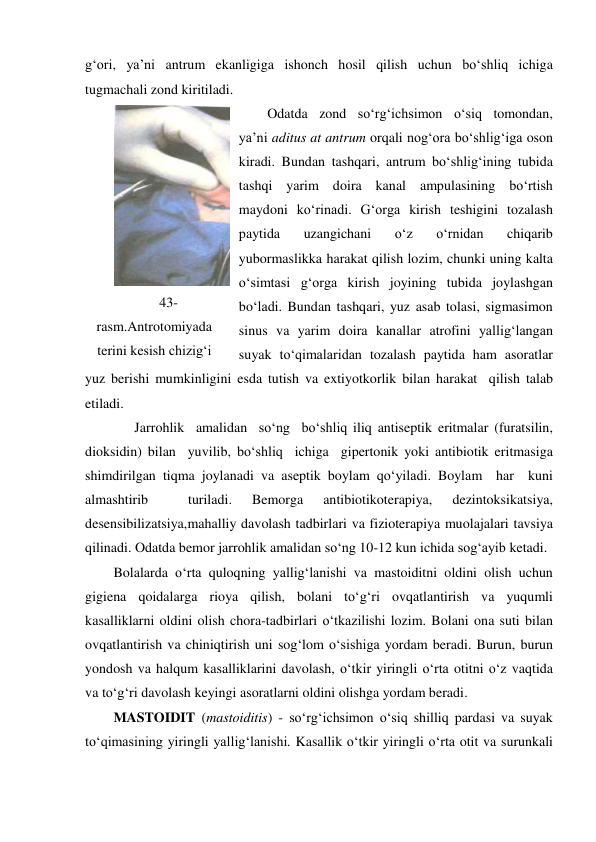 g‘ori, ya’ni antrum ekanligiga ishonch hosil qilish uchun bo‘shliq ichiga 
tugmachali zond kiritiladi. 
Odatda zond so‘rg‘ichsimon o‘siq tomondan, 
ya’ni aditus at antrum orqali nog‘ora bo‘shlig‘iga oson 
kiradi. Bundan tashqari, antrum bo‘shlig‘ining tubida 
tashqi yarim doira kanal ampulasining bo‘rtish 
maydoni ko‘rinadi. G‘orga kirish teshigini tozalash 
paytida 
uzangichani 
o‘z 
o‘rnidan 
chiqarib 
yubormaslikka harakat qilish lozim, chunki uning kalta 
o‘simtasi g‘orga kirish joyining tubida joylashgan 
bo‘ladi. Bundan tashqari, yuz asab tolasi, sigmasimon 
sinus va yarim doira kanallar atrofini yallig‘langan 
suyak to‘qimalaridan tozalash paytida ham asoratlar 
yuz berishi mumkinligini esda tutish va extiyotkorlik bilan harakat  qilish talab 
etiladi.   
      Jarrohlik  amalidan  so‘ng  bo‘shliq iliq antiseptik eritmalar (furatsilin, 
dioksidin) bilan  yuvilib, bo‘shliq  ichiga  gipertonik yoki antibiotik eritmasiga 
shimdirilgan tiqma joylanadi va aseptik boylam qo‘yiladi. Boylam  har  kuni  
almashtirib 
 
turiladi. 
Bemorga 
antibiotikoterapiya, 
dezintoksikatsiya, 
desensibilizatsiya,mahalliy davolash tadbirlari va fizioterapiya muolajalari tavsiya 
qilinadi. Odatda bemor jarrohlik amalidan so‘ng 10-12 kun ichida sog‘ayib ketadi. 
Bolalarda o‘rta quloqning yallig‘lanishi va mastoiditni oldini olish uchun 
gigiena qoidalarga rioya qilish, bolani to‘g‘ri ovqatlantirish va yuqumli 
kasalliklarni oldini olish chora-tadbirlari o‘tkazilishi lozim. Bolani ona suti bilan 
ovqatlantirish va chiniqtirish uni sog‘lom o‘sishiga yordam beradi. Burun, burun 
yondosh va halqum kasalliklarini davolash, o‘tkir yiringli o‘rta otitni o‘z vaqtida 
va to‘g‘ri davolash keyingi asoratlarni oldini olishga yordam beradi. 
MASTOIDIT (mastoiditis) - so‘rg‘ichsimon o‘siq shilliq pardasi va suyak 
to‘qimasining yiringli yallig‘lanishi. Kasallik o‘tkir yiringli o‘rta otit va surunkali 
 
43-
rasm.Antrotomiyada 
terini kesish chizig‘i 
