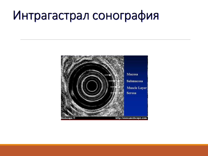 Интрагастрал сонография
