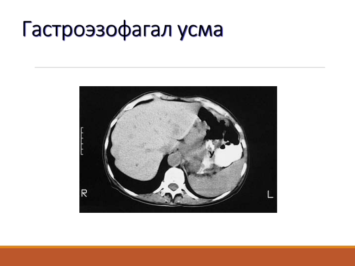 Гастроэзофагал усма
У
