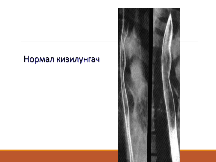 Нормал кизилунгач
