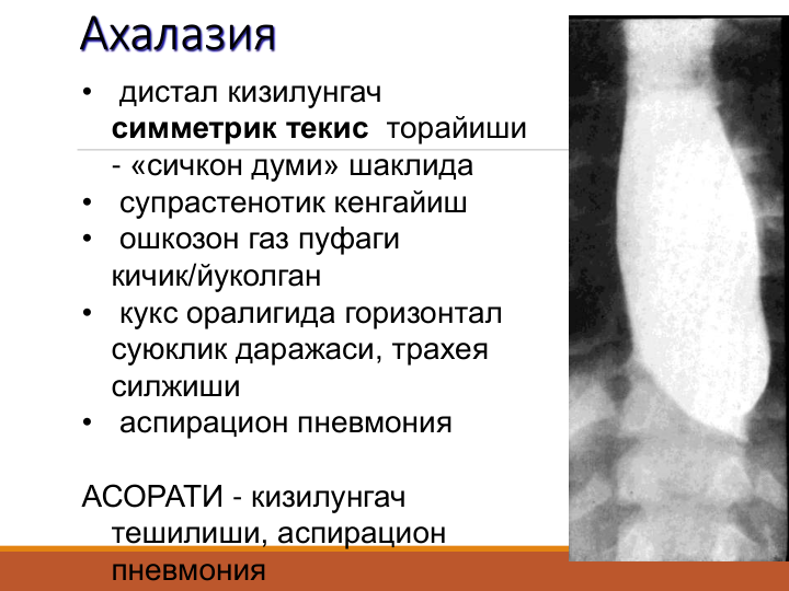 Ахалазия
•
дистал кизилунгач 
симметрик текис торайиши 
- «сичкон думи» шаклида
•
супрастенотик кенгайиш
•
ошкозон газ пуфаги 
кичик/йуколган
•
кукс оралигида горизонтал 
суюклик даражаси, трахея 
силжиши
•
аспирацион пневмония
АСОРАТИ - кизилунгач 
тешилиши, аспирацион 
пневмония
