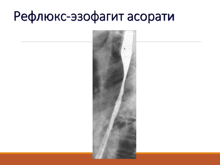 Рефлюкс-эзофагит асорати
