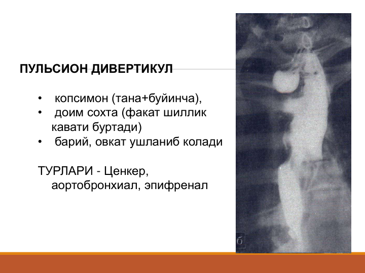 ПУЛЬСИОН ДИВЕРТИКУЛ 
•
копсимон (тана+буйинча), 
•
доим сохта (факат шиллик 
кавати буртади)
•
барий, овкат ушланиб колади
ТУРЛАРИ - Ценкер, 
аортобронхиал, эпифренал
